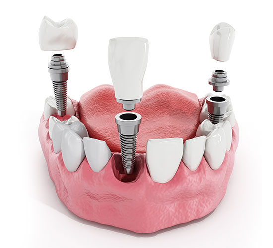 dental implant featured