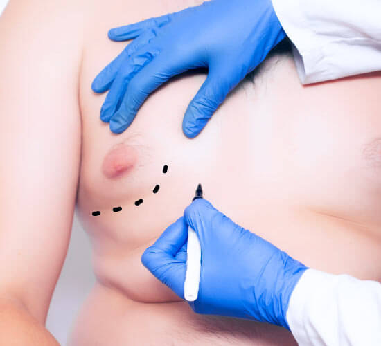 Gynecomastia surgery