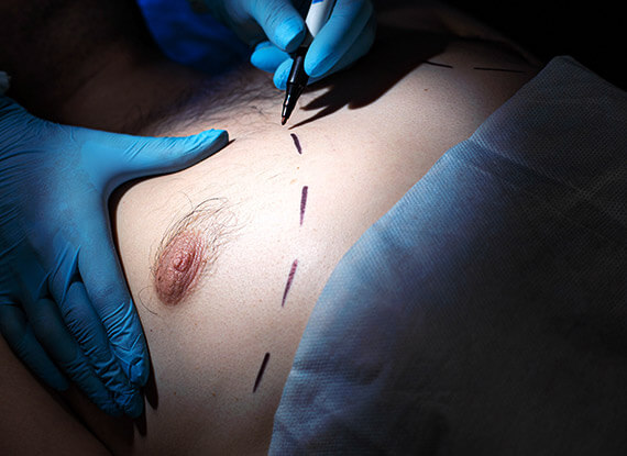 Gynecomastia surgery