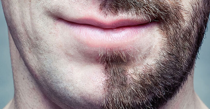 greffe de barbe
